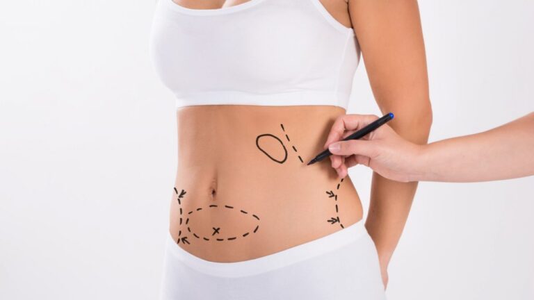 Liposuction Ameliyatı İçin Uygun Fiyatlar ve Kaliteli Hizmet