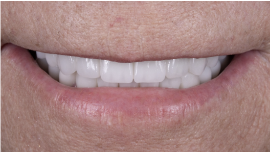 Transform Your Smile with Composite Veneers in Antalya